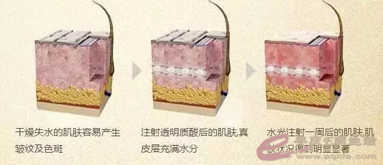 【科普】水光打针，打1次和4次毕竟有多年夜差别？